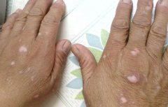 肢端型白癜风怎样护理?