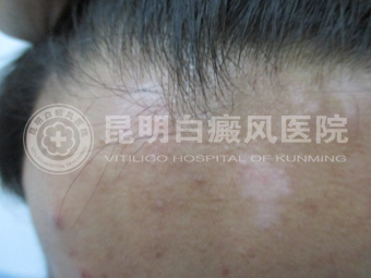 19岁男子面部白斑两年.jpg