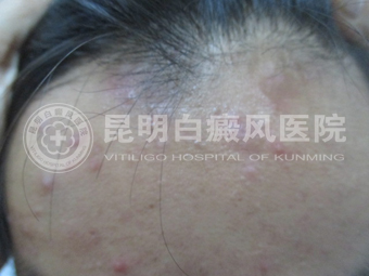 19岁男子面部白斑两年.jpg