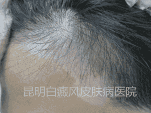 男性额头白斑一年余,在我院三个月康复