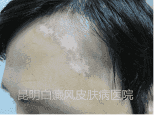 男性额头白斑一年余,在我院三个月康复